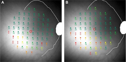 Figure 6 A closer inspection of threshold measures for Subject 9 at visits 2 (A) and 3 (B) show that the test grid has shifted temporally and rotated counterclockwise with respect to the optic disc and vascular arcades, causing complete discrepancy of scotoma mapping.