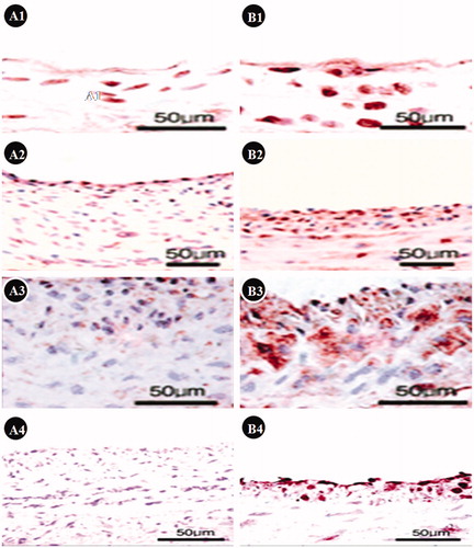 Figure 2. The results of TUNEL staining. A1, 2, 3, and 4 are 3, 7, 14, and 28  d after vascular injury in groups without treatment, respectively. We can see significant intimal hyperplasia, and less TUNEL-positive cells. B1, 2, 3, and 4 are 3, 7, 14, and 28 d after vascular injury in groups with atorvastatin treatment, respectively. We can see less intimal hyperplasia and more TUNEL-positive cells, indicated that atorvastatin can inhibit neointimal formation and induce SMCs apoptosis.