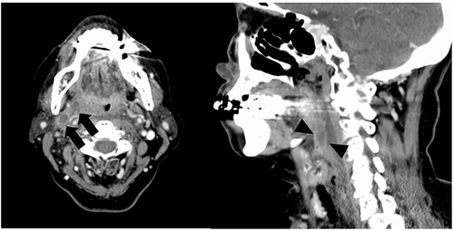 Figure 1 Enhanced computed tomography of the neck. Black arrow indicates a right peritonsillar abscess. Black arrowhead shows a retropharyngeal abscess.