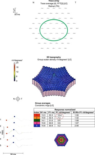 Figure 4 mfERG of a patient taking hydroxychloroquine at toxic doses who developed retinopathy.