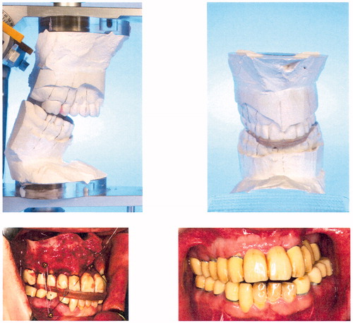 Figure 4. Upper row: The corresponding model situation for patient 2 before surgery (left) and after reorientation of the mandibulomaxillary complex. The desired occlusal relations are safeguarded by the virtually designed splint (right). Lower row: The corresponding situation during surgery. The occlusion of the mandibulomaxillary complex is safeguarded by the virtual splint (left). The final clinical situation (right) corresponds well to the virtually planned situation before surgery (Figure 3).