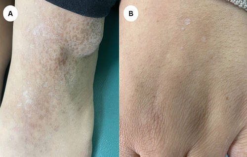 Figure 1 (A) Multiple shiny atrophic folliculocentric reticulated papules and plaques over the dorsum of the foot. (B) Few shiny pink flat topped papules over the dorsum of the hand.