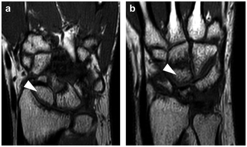 Figure 4. Magnetic resonance imaging (MRI) of the hand. T1-weighted MRI images showing proximal bone chips in both the scaphoid (a) and capitate (b) in high brightness. No impeded blood flow or necrosis was observed.