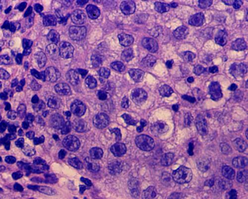 Figure 3 Ample coarse cells with atypical nuclei (magnification: 40×10).