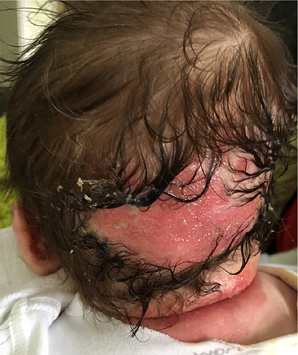 Figure 1 A chronic head wound with significant exudate in a neonate with JEB-GS.