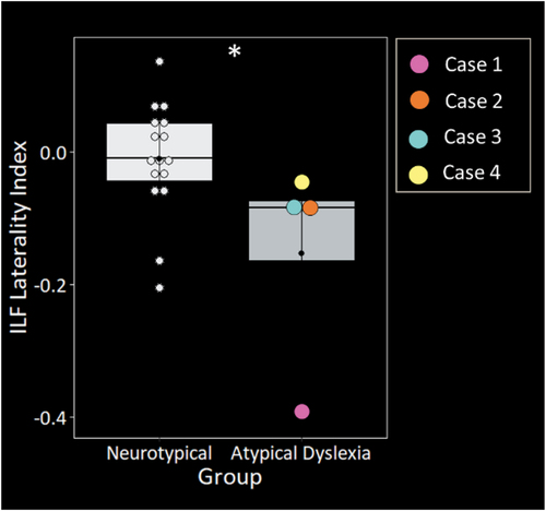 Figure 2. The four atypical presentations of dyslexia showed significantly greater structural asymmetry in the inferior longitudinal fasciculus (ILF) relative to neurotypical controls. Groups were matched on age, sex, and handedness. Asterisk denotes significant difference relative to neurotypical controls at *p<.05.