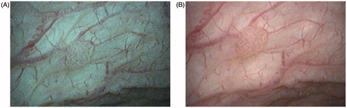 Figure 2. Bladder tumor stage Ta, low grade, examined by flexible cystoscopy using IMAGE1 S: (A) SPECTRA A; (B) SPECTRA B.