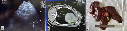 Figure 3 These figures depict the correlation between (a) Ultrasonography, (b) Computed tomography (CT) scan, and (c) Macroscopic findings. Green arrows indicate a solitary tumor found in subject #9 of DENA-treated swine using ultrasonography, CT scan, and macroscopic examination, respectively.