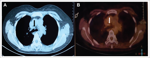 Figure 3. Chest CT and PET/CT showed the thymic mass was stable, which was not enhanced in chest contrast enhanced CT (A) and seen in PET/CT with a SUVmax of 1.8 (B).