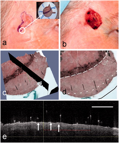 Figure 5. The clinical images of a nodular BCC from patient 3 before (a) and after (b) surgery, showing the clinical border and MMS defect, respectively. The dermoscopy image (inset) shows the fiducial marker in a selected position on a segment of the pre-surgical margin. (c, d) Corresponding 3D rendered dual OCT-dermoscopy images illustrating the selected plane (c) and the position of the clinical border (dotted lines) and surgical defect (black solid line) (d). (e) In this case, the OCT image from the selected plane shows few features of BCC either side of the clinical border apart from a thin epidermis (arrowed) throughout. Artefacts from hairs appear as vertical lines above the skin.