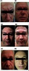 Figure 4 Color pictures of three subjects (1, 2 and 3) at baseline (A) and after 6 weeks of treatment with EDS (B).