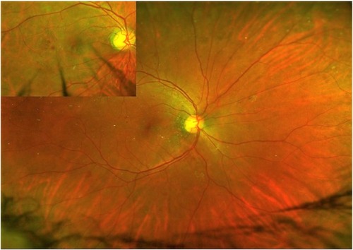 Figure 5 Widefield view of fundus suggestive of moderate NPDR. Inset shows the magnified view of one lesion area.