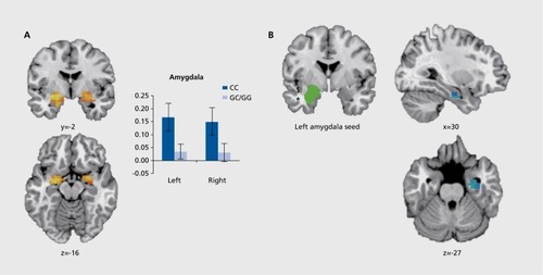 Figure 1. The ADCYAP1R1 risk allele (rs2267735) is associated with increased amygdala activation (A) and decreased amygdala-hippocampal connectivity (B) in traumatized women when viewing fearful faces (N=49). Adapted from reference 76: Stevens JS, Almli LM, Fani N, et al. PACAP receptor gene polymorphism impacts fear responses in the amygdala and hippocampus. Proc Natl Acad Sci U S A. 2014;111(8):3158-3163. Copyright© National Academy of Science 2014