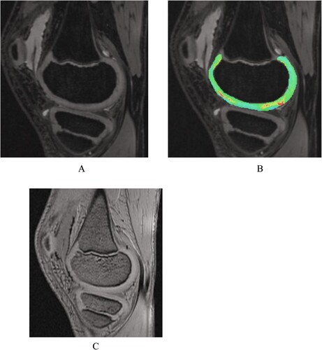Figure 3. Hemophilic arthropathy Experimental group A Male 9 years old. (A) The 3D-DESS image showed intact articular cartilage morphology of the medial femoral condyle of the right knee joint with no obvious signal abnormalities. (B) T2 mapping pseudo-color image showing an uneven distribution of cartilage color scale, uneven color scale in the weight-bearing area of articular cartilage with a small amount of red-yellow scale, and significantly elevated cartilage T2 value. (C) MRI SWI showing a small amount of hemosiderin on the anterior-posterior border of the articular suprapatellar capsule and femoral cartilage. The MRI SWI shows a small amount of iron-containing hematoxylin in the suprapatellar capsule and the anterior-posterior border of the femoral cartilage.