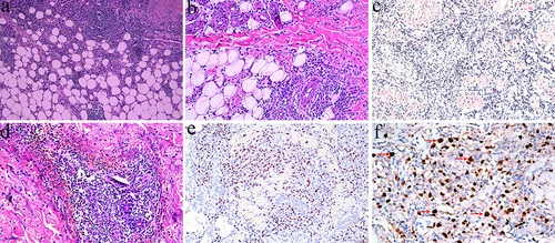 Figure 2 Microscopic pathological features of HVLPD patients. (a) (HE 200X) and (b) (HE 400X) A large number of mildly profiled lymphocytes infiltrated the subcutaneous fat. (c) (HE 200X) A large number of plasmacytoid lymphocytes infiltrated the shallow and deep dermis. (d) (HE 400X) Lymphoid cells invaded sweat glands and vascular walls. (e) (200X) EBER expression was strongly positive in 6 patients. (f) (400X) EBER positive lymphocytes infiltrated subcutaneous tissues and individual nuclei showed atypia as indicated by the red arrows.