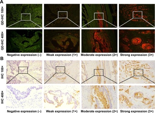 Figure 5 Representative images based on LEA expression levels in CRC tissues using (A) QD-IHC and (B) conventional IHC.Notes: According to the stain intensity, LEA expression levels were classified into four groups, negative expression (−), weak expression (+), moderate expression (2+), and strong expression (3+). A low-power field (×100) and a sequentially enlarged field (×400) were selected.Abbreviations: QD-IHC, quantum dot-based immunohistochemistry; IHC, immunohistochemistry; CRC, colorectal cancer; LEA, large external antigen.