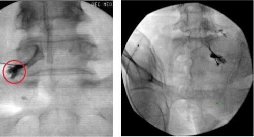 Figure 1 Radiculogram demonstrating needle placed near the dorsal root ganglion at L5 (left) and S1 (right).