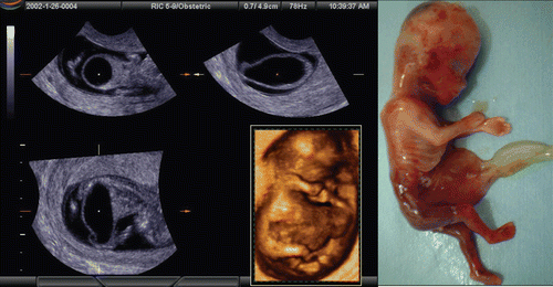 Figure 51.  Prune-berry syndrome at 11 weeks of gestation (monochromatic figures) 3D orthogonal views of coronal (left upper), axial (middle upper) and sagittal (left lower) sections. Huge bladder of prune-berry shape and fragile abdominal wall are visible. (middle lower) 3D imaging of the fetus. (right) Macroscopic picture of aborted fetus.