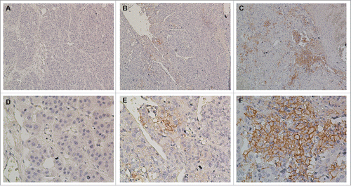 Figure 2. Immunohistochemical analysis of PD-L1 expression in primary hepatocellular carcinoma surgical specimens. Positive staining results are reported as the percentage of tumor cells showing membranous PD-L1 expression (frequency). (A and D) PD-L1 expression was scored as <1%, (B and E) PD-L1 expression was scored as 1–5%, (C and F) PD-L1 expression was scored as ≥5%. PD-L1 staining is indicated by the presence of brown chromogen. Blue represents the hematoxylin counterstain (A–C, 100× magnification; D–F, 400× magnification).