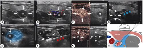 Figure 1. (A, B) B scan ultrasound and color Doppler imaging showing a right sided inferior parathyroid adenoma (white arrow, M), (C) image after injection of ultrasound contrast, (D) image demonstrating the position of the RFA needle (blue arrow), (E) layer of hypoechoic fluid along the adenoma (blue region) created by hydro-dissection, (F) image during RF ablation depicts parathyroid adenoma (M) and RFA needle (red arrow), (G) CEUS post-procedure demonstrating complete ablation, (H) schematic illustration depicting the procedure and its limits. RFA: radiofrequency ablation; CEUS: contrast-enhanced ultrasound.