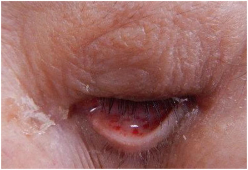 Figure 3 Physical findings second day after injury. Petechiae developed on the palpebral conjunctiva.