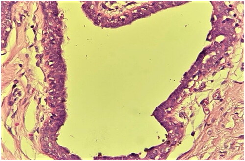Figure 4. High power view showing a duct lined by a three-layer epithelium (luminal, intermediate and myoepithelial), cuffed by a loose stroma. (40× Magnification; Hematoxylin-Eosin staining).