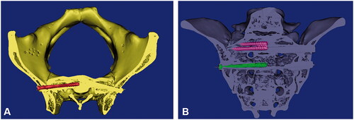 Figure 3. CT scan was used to evaluate the accuracy of sacroiliac screws insertion. (A): Measurement of the anterior and posterior offset angles (α) on cross section. The red solid line represented the preoperative simulated screw channel axis, and the black solid line represented actual screw channel axis; (B): Measurement of the upper and lower offset angles (β) on the coronal plane. The red solid line represented the preoperative simulated screw channel axis, and the black solid line represented actual screw channel axis.