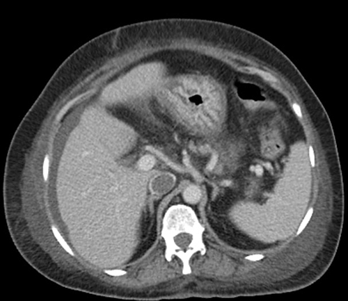 Figure 3 Contrast-enhanced CT image at the level of the diaphragm shows a filling defect (thrombus) in the inferior vena cava. and perihepatic free fluid.