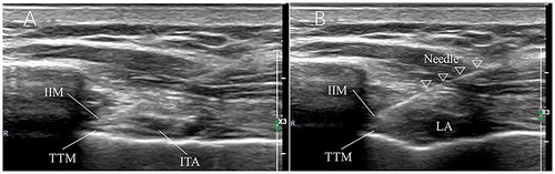 Figure 1. A. Ultrasonographic image of DPIP block. B. Triangle icons indicate the needle track. Local anesthetics were spread in the layer between IIM and TTM. DPIP block – Transversus thoracic muscle plane block. IIM – internal intercostal muscle. Transversus thoracic muscle – TTM.
