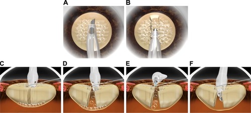 Figure 2 Bypassing the front and back of the intracapsular lens and degassing by the phaco tip and hook prior to hydrodissection induces a reduction in the intracapsular volume and pressure.