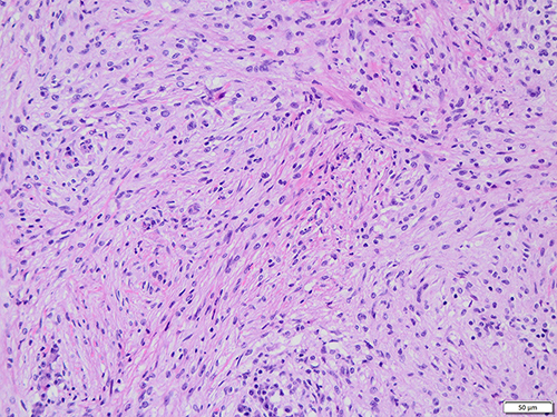 Figure 4 Obvious fibrous tissue hyperplasia with storiform structure in some areas (HE).