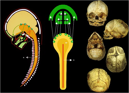 Figure 1. A schematic overview of cranial development from the neural crest. Left: The dark yellow structure (NT) illustrates the neural tube. The notochord (n) is drawn as a red line passing through the vertebral corpora. The green structures are the facial bones developed from the neural crest. Four segments of neural crest cells are schematically demonstrated. These cells arise from the rim of the neural crest, marked by green dots (a, b, c, d), and from here, they follow the pathways (arrows) toward the anterior aspects of the face. The yellow structures illustrate the hemispheres, and below the hemispheres is the cerebellum. Center: This figure is a schematic drawing of the left illustration seen from behind. The notochord is a red line (n) and the dark yellow (NT) is the neural tube. Note that the four green dots (a, b, c, and d) appear on the right side and also on the left side of the neural tube. This is important for the understanding of unilateral malformations only involving the right or left neural crest. The arrows from the green dots indicate a pathway for the migrating cells to the jaws. Right: A seemingly normally developed perinatal cranium, seen from top to bottom. The cranium might be slightly deformed during storage and appear slightly asymmetrical. As this is a perinatal cranium, the teeth have not erupted. In the posterior view, Wormian bones appear, and the occipital squama appears divided into a lower and an upper bulging part. The upper part has a desmal origin, developed like the parietal bones. The lower part has a cartilaginous origin, comparable to the cartilaginous development of arches in the vertebrae.