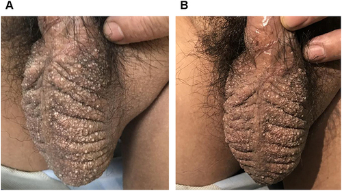 Figure 1 (A and B) The patient had bilateral scrotal enlargement, scrotal skin thickened, significantly deepened scrotal fold, the scrotal surface can be seen needle tip to the size of a grain of rice white blisters, blisters thick wall, part of the blisters fused.