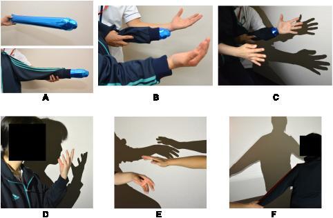 Figure 1 Body shadow methods. (A–C): 1st step, (D): 2nd step, (E): 3rd step, (F): shoulder adduction and abduction while looking at the body shadow. A cylindrical balloon was passed through the left sleeve of a long-sleeve shirt to imitate the patient’s left arm (A). The patient wore the shirt but did not pass her left arm through the sleeve; her left hand was projected as a shadow using the therapist’s left hand (B). When the body was projected, the patient repeatedly flexed and extended her right-hand fingers; the therapist also flexed and extended the fingers on his left hand in synchronization with the patient’s hand (C). Consequently, the patient’s motor intention and the visual feedback of the shadow formed an SoO and SoO over the body shadow of the left hand. Next, the imitated left arm was replaced with the patient’s own left arm. Consequently, using her body shadow, the patient was able to “touch” her face (D) and another person’s projected hand (E). Later, a body shadow of the patient’s whole body was projected, and she performed adduction and abduction of both shoulders while looking at the body shadow (F).