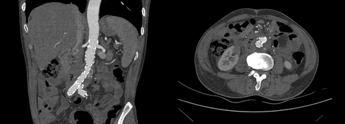 Figure 2 Two weeks after endovascular repair of the abdominal aorta, a liquid dark area appeared around the abdominal aorta with visible bubbles.