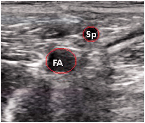 Figure 3. Ultrasound scan of the treatment region from case 2. The saphenous artery (Sp) traversed superficially to the femoral artery (FA) to come within the path of the incident HIFU beam.