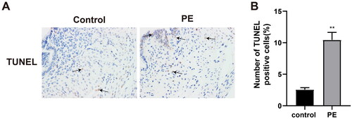 Figure 3. Cell apoptosis in placental tissues. TUNEL staining was used to assess levels of cell apoptosis in all harvested human placental tissues. **p < 0.01 vs. control group. Control group, n = 23; PE group, n = 18.