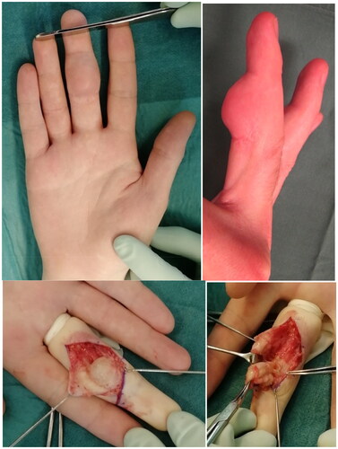 Figure 2. Patient number 2 in Table 2 operated with tendon repair two days after injury using 4-0 FiberLoop® sutures. After seven months, he presented with a gradually increasing volar non-tender nodule. After skin incision, a cystic granuloma was found surrounding the suture material.