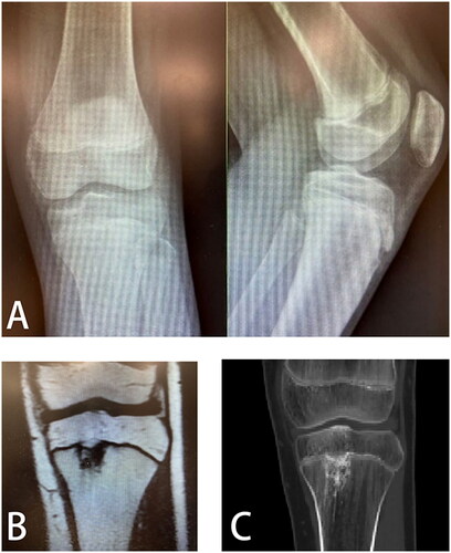 Figure 4. (A) Lesions are not visualized on anteroposterior and lateral X-ray radiographs of the knee; (B) CT images of the lesion; (C) MRI images of lesions.