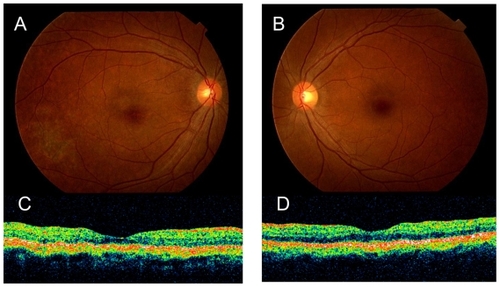 Figure 5 Fundus photography of the right A) and the left eye B) one month after chemotherapy. The ocular lesions have completely resolved leaving atrophic pigmentary changes. Optical coherence tomography of the macular area of the right C) and the left eye D) shows that the massive subretinal infiltration of the right eye has disappeared.