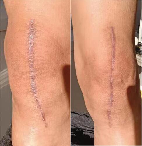 Figure 4 The appearances of bilateral incisions at postoperative two month (right: tissue adhesive group; left: control group).