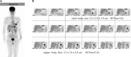 Figure 2.  (A) The projection view of FDG-PET showed a focal area with intense FDG uptake in the inner left upper quadrant of the abdomen. (B) Serial coronal views of the delayed images with distend stomach revealed two separate tumors. The SUVm of the lesions was 9.4 and 13.2, respectively.