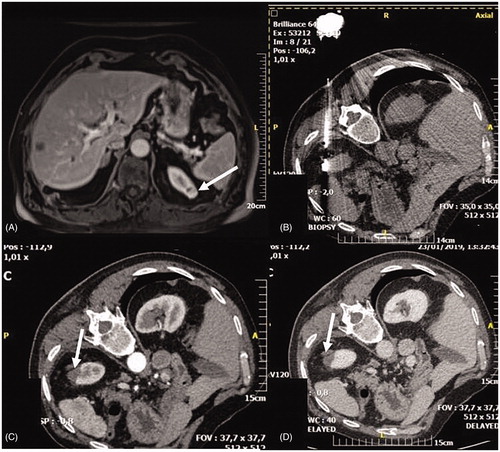 Figure 2. MWA of renal cell carcinoma (biopsy proven) located in the apex of the left kidney. (A) T1-weighted fat saturated sequence post IV contrast medium injection depicting the lesion (arrow) in the apex of the left kidney. (B) Patient was placed in lateral decubitus position – a microwave antenna was inserted and ablation session was performed according to the provided dimensions on terms of energy (W) and time (min). (C, D) Computed tomography scans in arterial (C) and venous (D) phases illustrating complete tumor ablation (arrow).