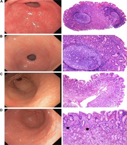 Figure 2 Endoscopic and histological correlation in patients with nodularity and non-nodularity images.