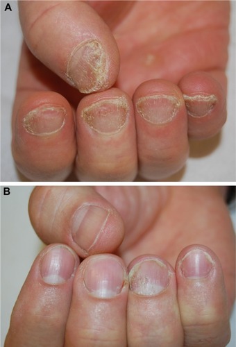 Figure 6 Nail psoriasis (A) before and (B) after treatment with acitretin.