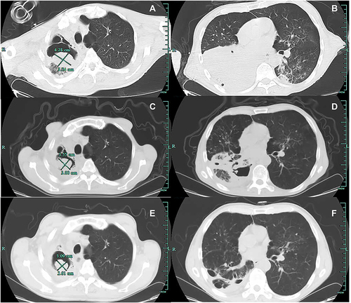 Figure 1 CT scan on admission (A and B), 2 months later (C and D) and 1 year later (E and F). (A and B) Axial CT images showed a thick-walled cavity in the right upper lobe containing a 4.28 cm*3.54 cm soft tissue opacity consistent with pulmonary aspergilloma and a mass of consolidation in the right lower lobe and patchy nodules shadows in the left lower lobe. (C and D) Axial CT images showed the fungal ball had been absorbed to 3.55 cm*3.00 cm and the clear left lower lobe, consolidation had been mostly absorbed. (E and F) Axial CT images showed the fungal ball had been further absorbed to a 3.09 cm*2.61 cm, and consolidation had been further absorbed.