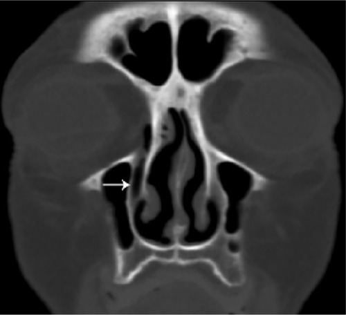 Figure 5 Coronal image illustrating a fully or partially aerated nasolacrimal duct (arrow).
