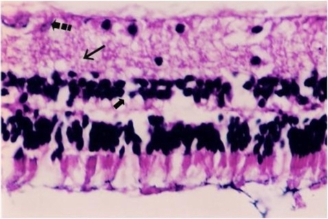 Figure 3 Drug: Histological photograph of hydropic degeneration of a few ganglion cells (broken arrow), slight edema of inner plexiform layer (long arrow), and hydropic degeneration of a few cells in inner nuclear layer (short arrow).