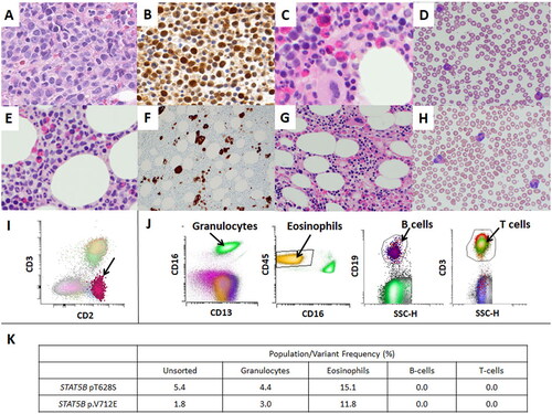 Figure 1. Microscopic pictures of myeloid neoplasms with STAT5B mutations (A–F) and bone marrow of a patient with peripheral T-cell lymphoma (PTCL)-NOS with STAT5B mutation (G–H). (A) Marrow shows sheets of myeloblasts (Case #1, Bone marrow biopsy, HE ×400), (B) pSTAT5 immunohistochemistry shows immunoreactivity in myeloblasts (Case #1, Bone marrow biopsy, pSTAT5 × 400), (C) eosinophils and precursors are increased (Case #4, Bone marrow biopsy, HE x400), (D) peripheral blood shows increase in eosinophils (Case #4, Peripheral blood, Giemsa x500), (E) eosinophils and precursors are increased (Case #5, Bone marrow biopsy, HE ×400), (F) CD61 highlights numerous dysplastic megakaryocytes (Case #5, Bone marrow biopsy, CD61 × 200), (G) bone marrow shows increased eosinophils and precursors (PTCL-NOS, Bone marrow biopsy, HE ×200), (H) peripheral blood shows increase in eosinophils (PTCL-NOS, Peripheral blood, Giemsa ×500), (I) flow cytometry performed with bone marrow aspirate sample of PTCL-NOS patient shows small abnormal T-cell population with loss of surface CD3 (0.26% of total WBC), consistent with minimal bone marrow involvement by PTCL-NOS. (J) flow sorting was performed with a peripheral blood sample of Case #4 to isolate granulocytes, eosinophils, B-cells and T-cells to further perform NGS in each population, (K) The results of subsequent next generation sequencing in each population of Case #4. STAT5B mutations were identified in granulocytes and eosinophils, but not in B-cells or T-cells.