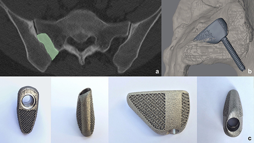Figure 3 (a) The canyon shape of the recess (green), (b and c) determines the wedge shape of the custom implant.